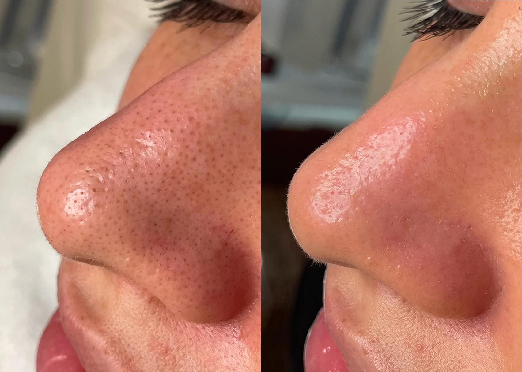 Før og etter – renere porer etter Hydrabeauty Facial